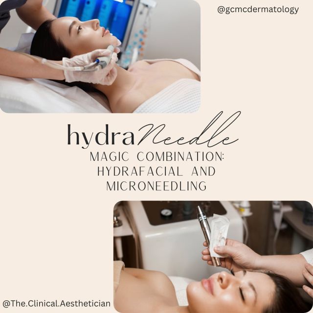 This magic combo is on special this month for $375!
📍Trinity and Port Richey, FL

✨Hydrafacial: deep pore cleansing with vortex technology and infusions of serums and antioxidants giving your skin hydration and that signature glazed donut glow 

✨Microneedling: tiny sterile punctures to the skin that triggers new collagen and elastin production to promote firmer, smoother, and more even tone. Great for large pores, non active acne, fine lines and wrinkles, scars and stretch marks! 

#microneedling #hydraneedle #hydraneedling #hydrafacial #skincare #marchspecials #tampaesthetician #portrichey #trinity #skincareservices #skincaretreatment #facialtreatment #facialspecialist #flesthetician #glowingskin #youngerskin #treatyourself #skinhealth #youresthetician #beautifulskin #allskintypes #allskincare #skincareduo #magicskincare #magicpair #magiccombo