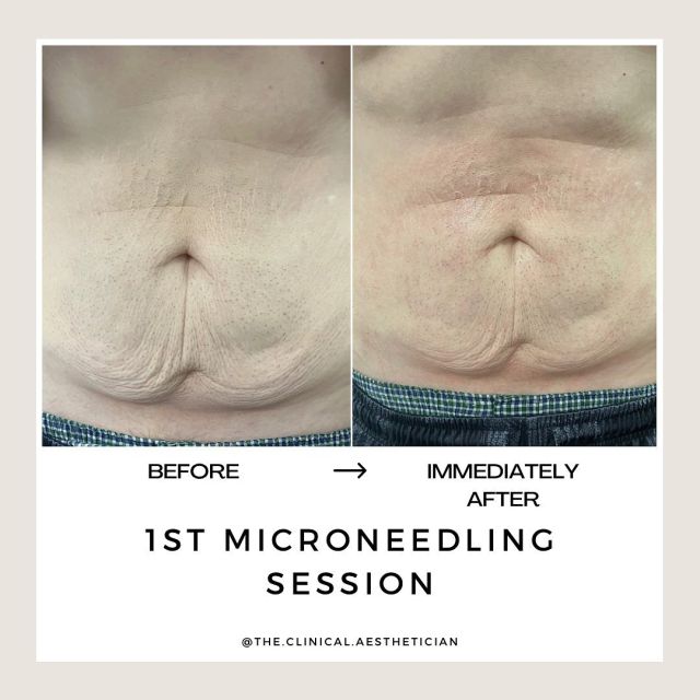 Microneedling isn’t only for your face! The tiny injuries from microneedling stimulate the body to form new skin cells that add structure and strength that fight aging and sagging, like elastin and collagen. A series of microneedling treatments can improve elasticity, appearance of scars, rosacea, acne, and the appearance of pores. 
Book your consultation with our medical esthetician to see if this is the best treatment for you!

#microneedling #saggingskin #weightloss #elasticity #collagen #skinpen #skinpenmicroneedling #tightenskin #stretchmarks #aesthetics #medicalesthetician #medicalaesthetics #beforeandafter #skintreatment #bodytreatment #acne #acnetreatment #acnescars #rosaceatreatment #skincare #skincaretreatment #skinimprovement #treatyourself #microneedle #treatmentseries